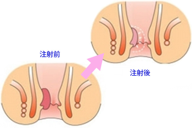 ALTA四段階硬化療法での改善の例