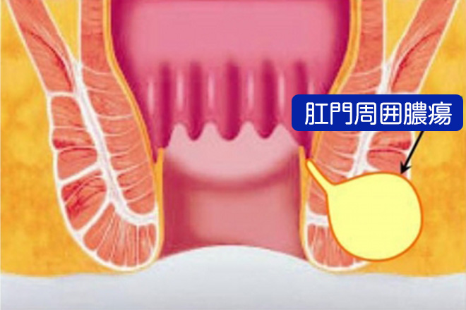 肛門周囲膿瘍