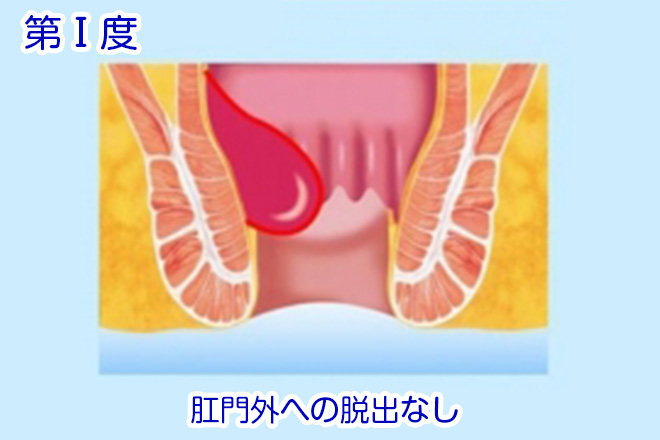 第Ⅰ度の内痔核