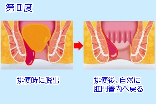 第Ⅱ度の内痔核