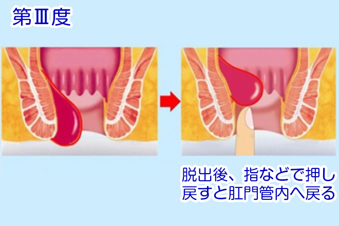 第Ⅲ度の内痔核